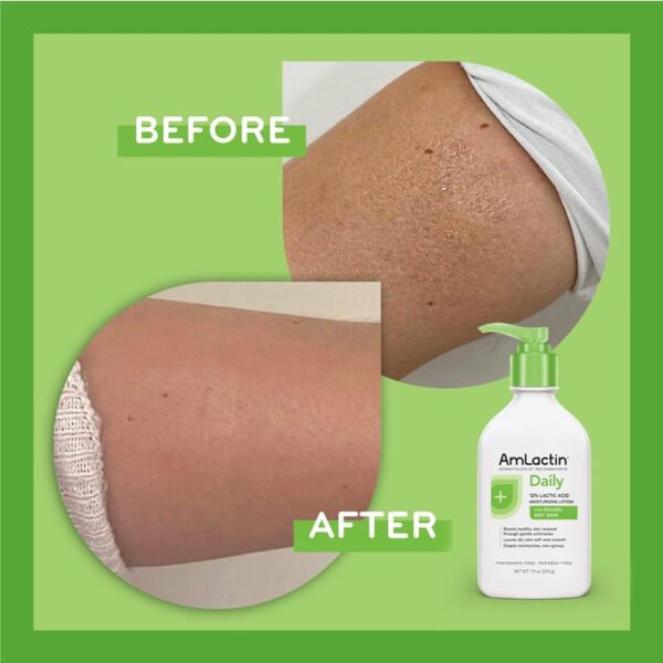 AmLactin Daily 12% Lactic Acid Moisturizing Lotion for Rough and Dry Skin – 400gm - Image 2